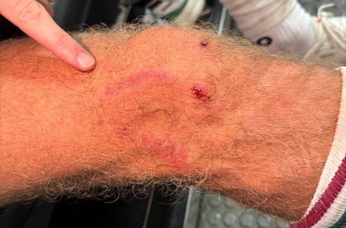 Castillo mostra como ficou o joelho após entrada de Pulgar; volante do Flamengo só levou amarelo